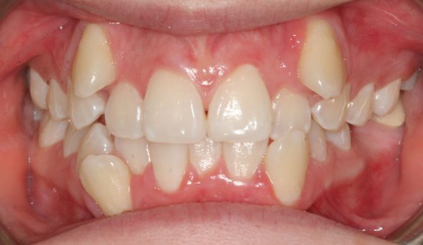 Tình trạng răng khấp khểnh